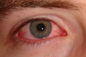 Conjunctivitis